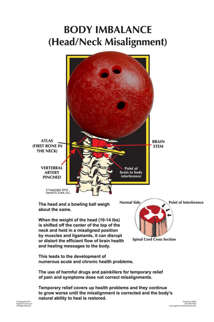 BODY IMBALANCE (Head/Neck Misalignment)